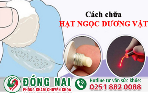 Cách Trị Chuỗi Hạt Ngọc Dương Vật