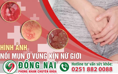 Những loại mụn ở vùng kín của nữ giới