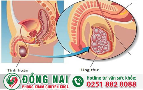 Nguyên Nhân Gây Nổi Hạch Ở Bộ Phận Sinh Dục Nam